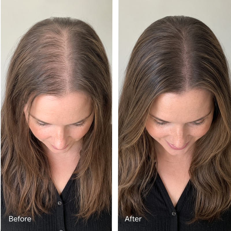 GLP-1 Hair Loss: Why Hair Can Shed During Weight Loss + How to Support the Scalp